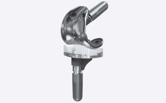 Total Knee Arthroplasty (TKA) | Spartan Medical